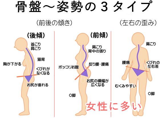 骨盤・姿勢の歪み３タイプ